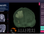 f_사진 1. ‘MedNeuro3D’ AI 기반3D 뇌 구조 모델링 후 최적 수술 경로 시뮬레이션 결과.png